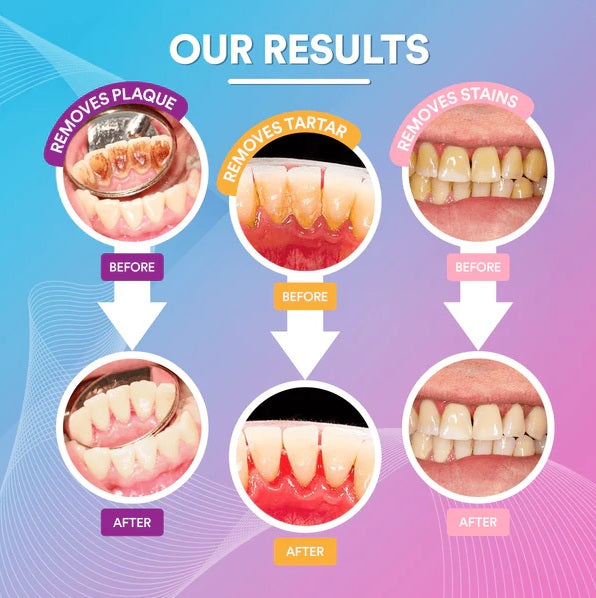 Portable Electric Sonic Tooth Scaler Tooth Cleaner Calculus Stains Tartar Remover Tool Teeth Whitening Oral Hygiene Dropshipping