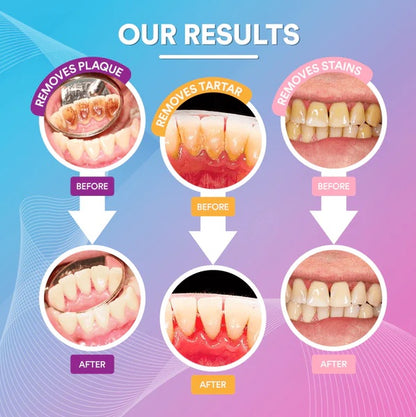 Portable Electric Sonic Tooth Scaler Tooth Cleaner Calculus Stains Tartar Remover Tool Teeth Whitening Oral Hygiene Dropshipping